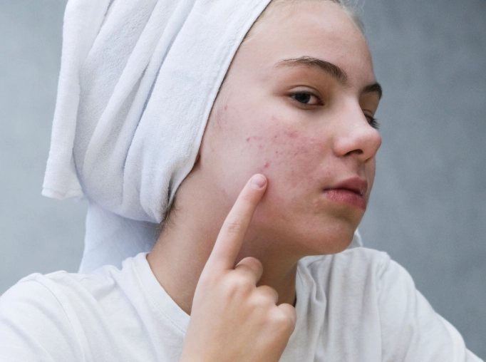 口服痘痘藥 口服痘痘藥