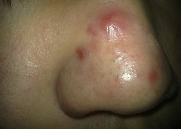 青春痘口服抗生素