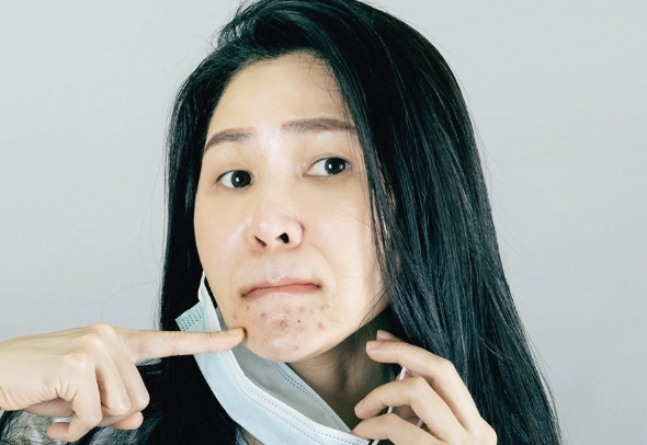 口服A酸痘痘藥 口服A酸痘痘藥