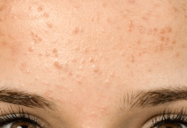 青春期痘痘保養