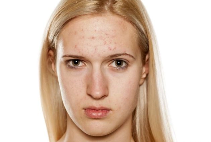 口服A酸痘痘治疗