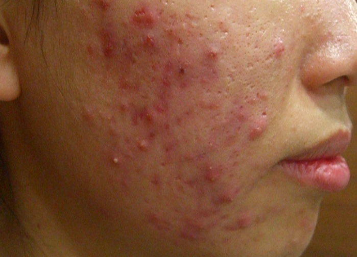 青春期痘痘保養