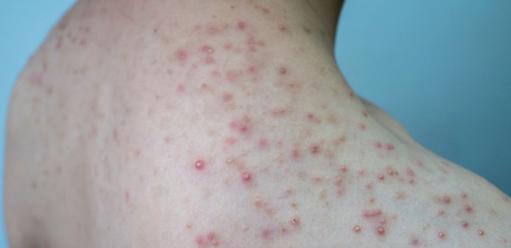 痤瘡桿菌毛囊炎治療