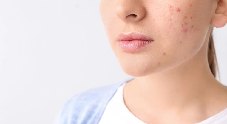 丘疹型痘痘處理方法