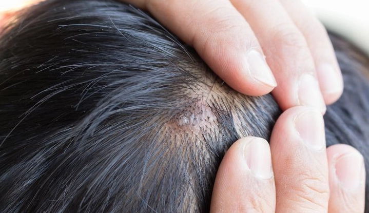 痤瘡桿菌頭皮治療 痤瘡桿菌頭皮治療