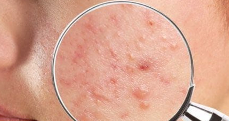 痤瘡桿菌毛囊炎症狀