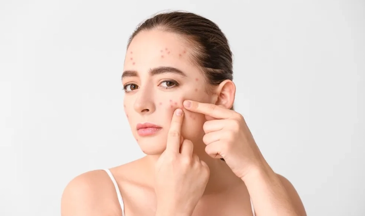 痘痘反覆發作原因