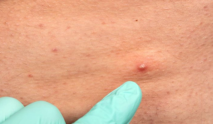 毛囊炎預防方法