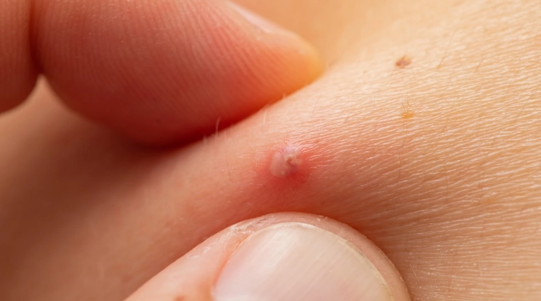 痤瘡桿菌毛囊炎症狀