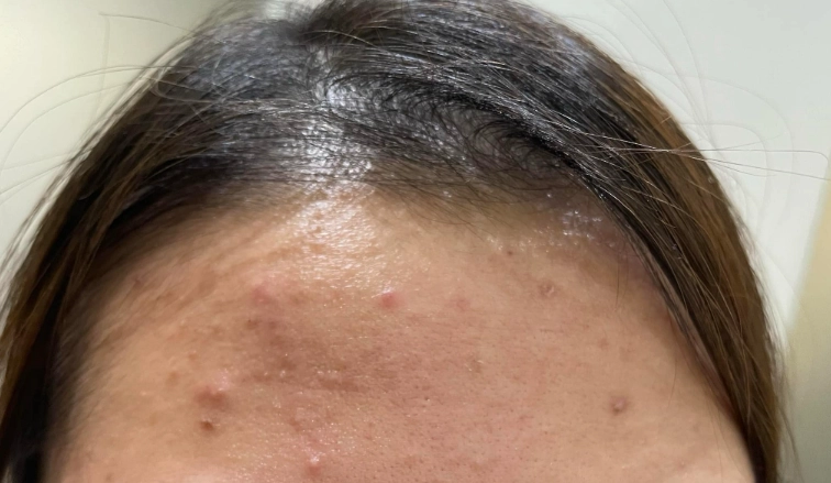 毛囊炎預防方法