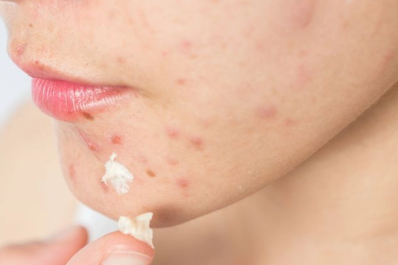 丘疹型痘痘處理方法