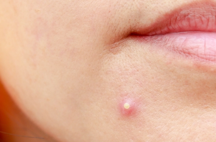 痘痘反覆發作原因