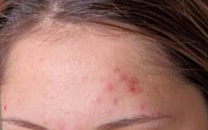 丘疹型痘痘處理方法