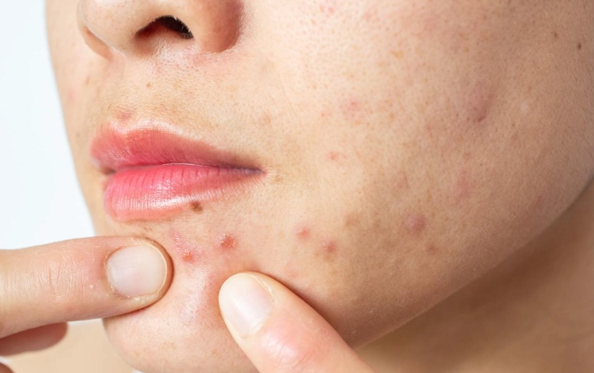 抗生素引起痘痘