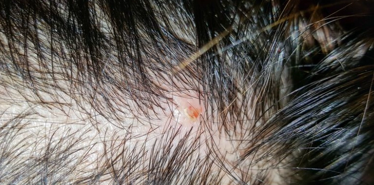 痤瘡桿菌感染頭皮 痤瘡桿菌感染頭皮