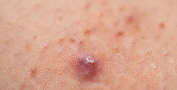 痤瘡桿菌毛囊炎治療