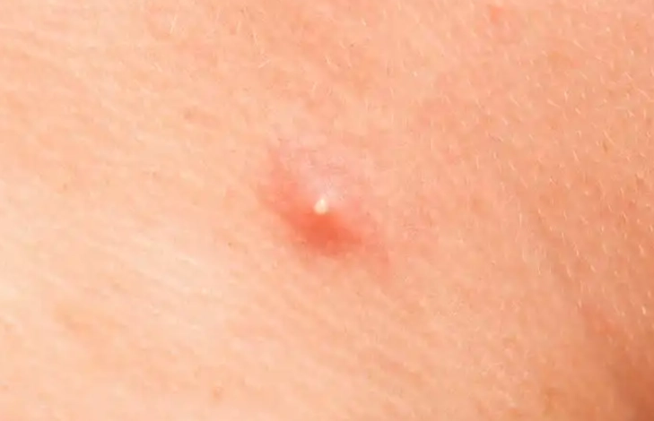 丘疹型痘痘痘痘貼