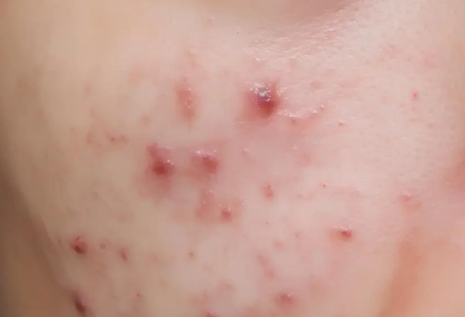 痤疮丙酸杆菌治疗