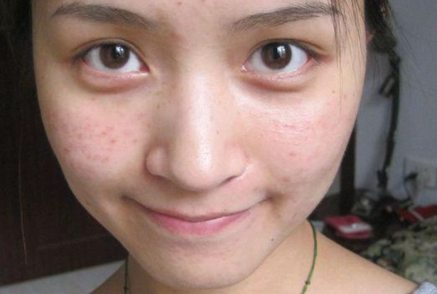 青春期長痘痘飲食