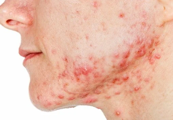 痤疮和痘痘的区别