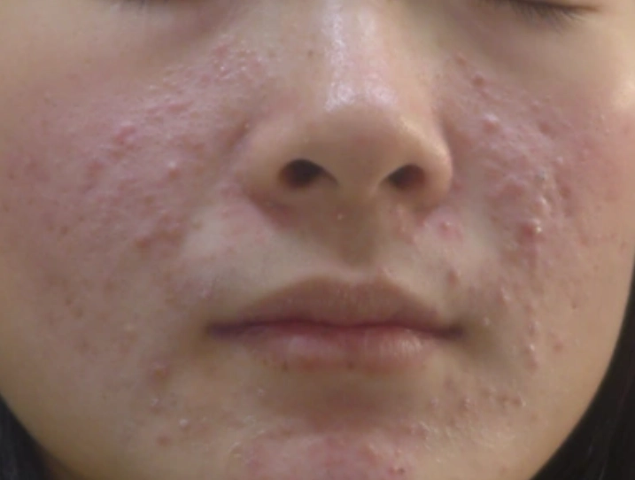 丘疹型痘痘原因