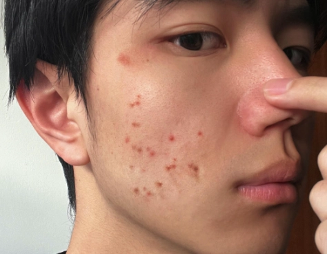 痘痘消炎药口服