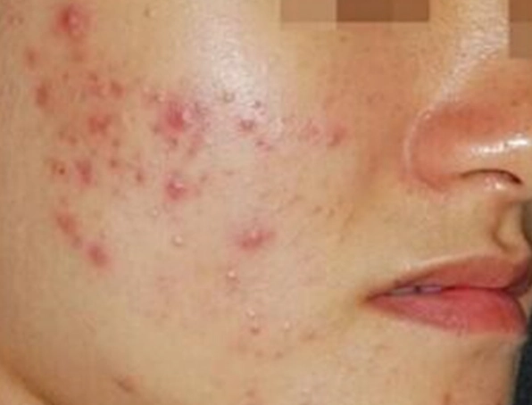 囊腫型痘痘種類