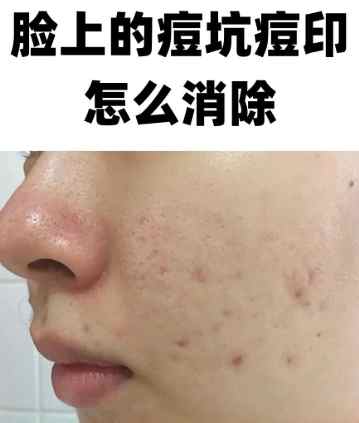 痘印如何消除