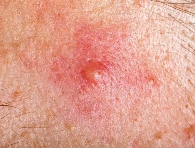 囊腫型痘痘怎麼處理