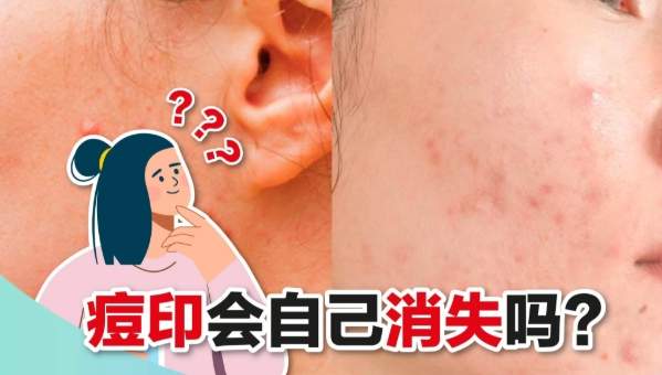 痘印會自己消嗎