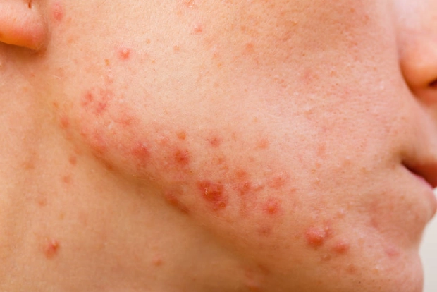 青春期痘痘洗面乳