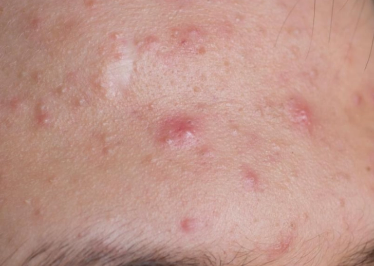 囊腫型痘痘多久好