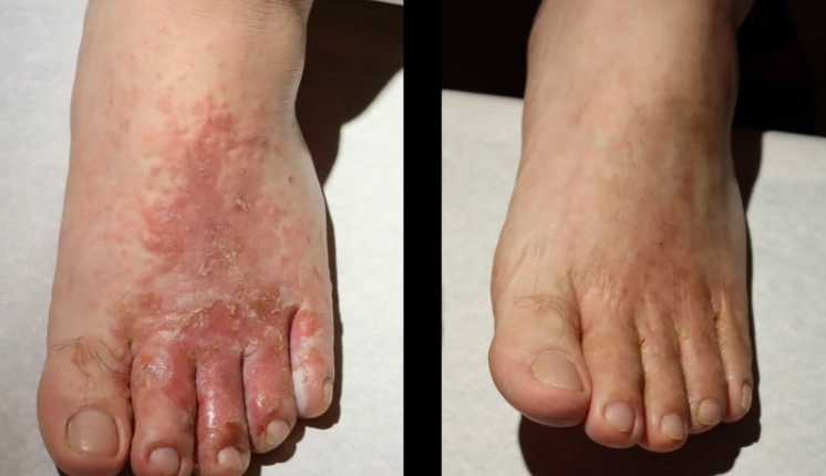 天然治香港腳方法 天然治香港腳方法