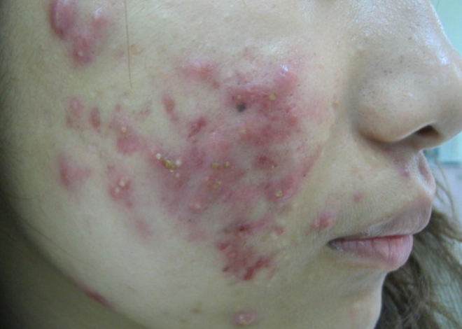 青春期痘痘要看醫生嗎