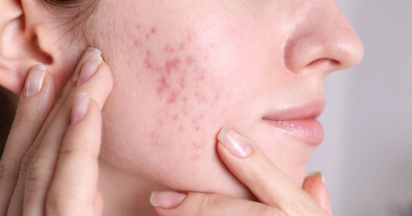 痘痘肌保養