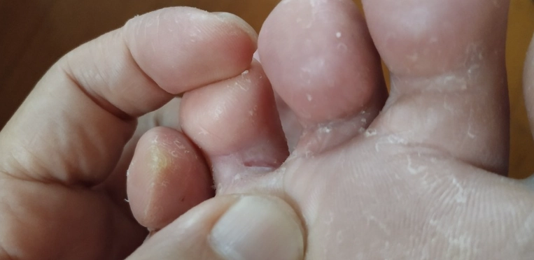 小蘇打粉治香港腳