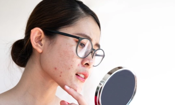 青春期痘痘怎麼消