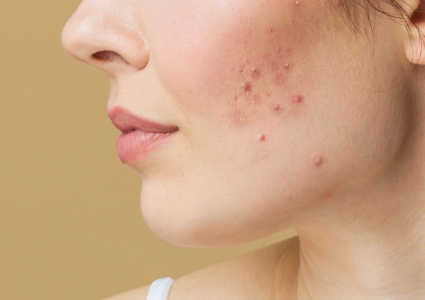 青春期長痘痘怎麼辦