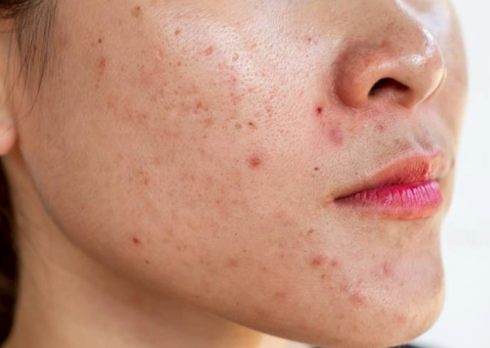 青春期長痘痘保養