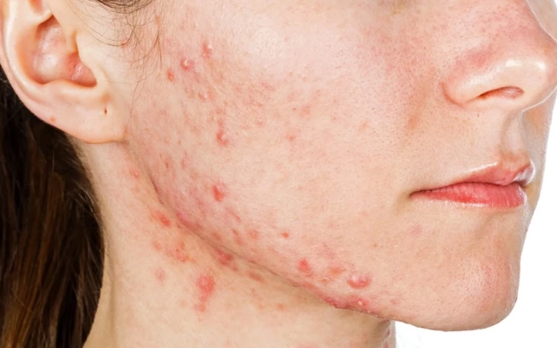 痤瘡桿菌毛囊炎