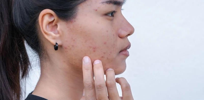痘痘肌保養 痘痘肌保養